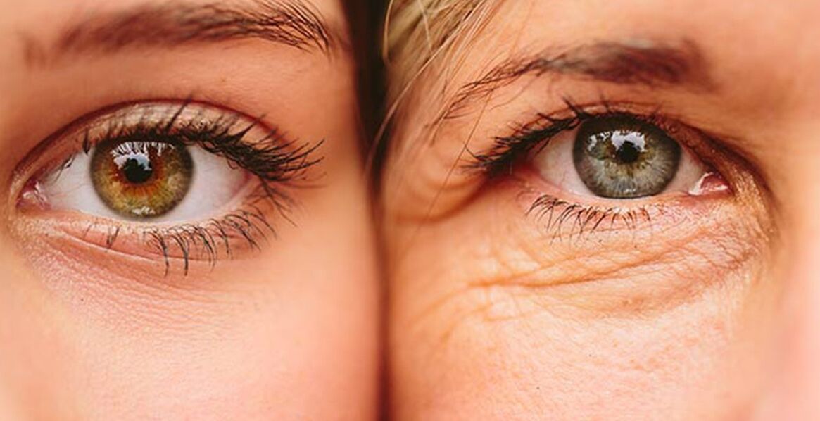 Dviejų skirtingo amžiaus moterų išoriniai odos senėjimo požymiai aplink akis